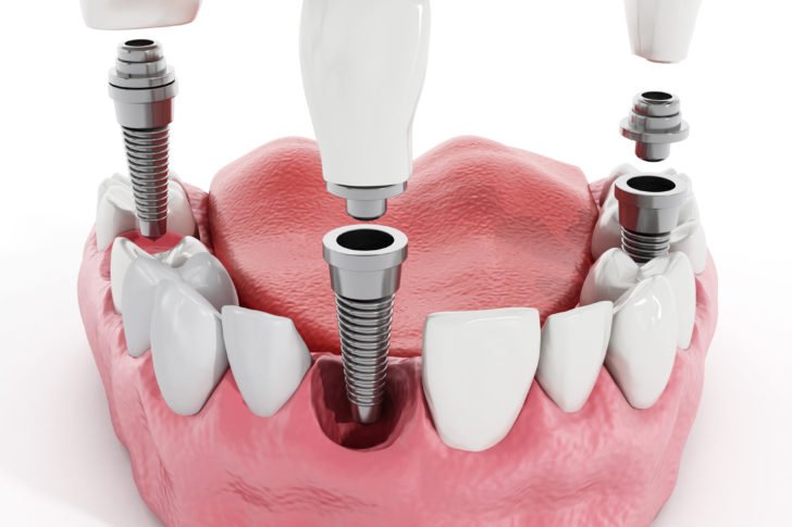 Illustration of teeth showing dental implant structure